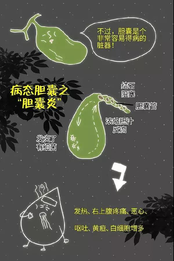 胆石专家帮您壮胆---解决病态胆囊