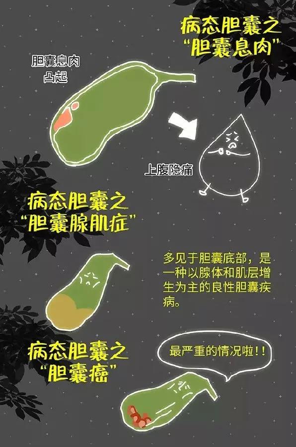 胆石专家帮您壮胆---解决病态胆囊